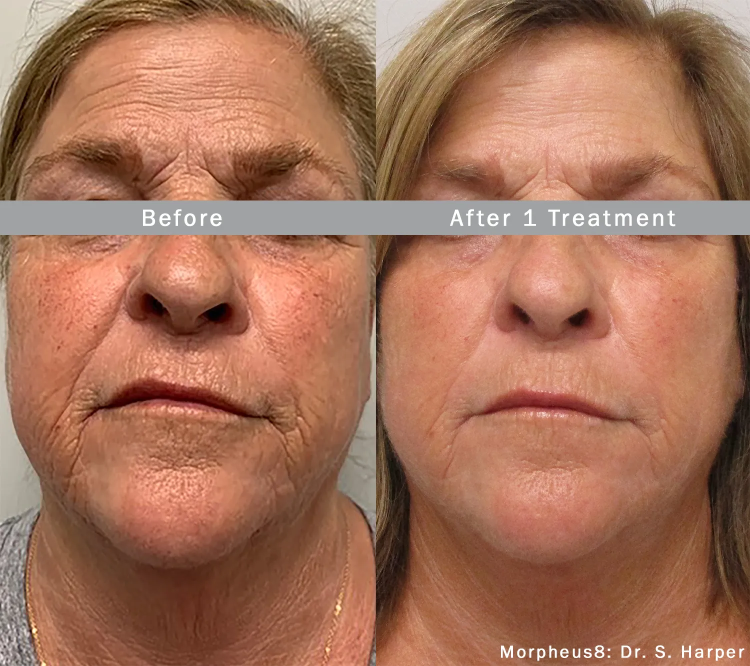 Before and After Morpheus8 Single Treatment